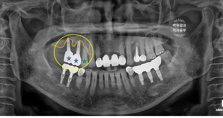 60대 임플란트 주변에서 고름이 나와요. 실패한 임플란트 제거 후 재수술. 덴티움 뼈이식재를 사용한 치조골 이식술. 관련 이미지 17