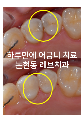 옆면 어금니 충치 하루만에 가능한 논현동 치과. 치아미백 가격 후기. 관련 이미지 1