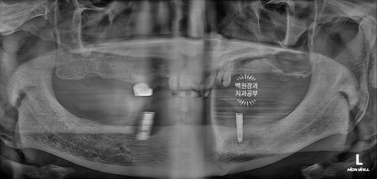 임플란트틀니 - 오버덴쳐. 오스템BA임플란트 이용한 최고의 가성비 치료. 치료과정/치료기간/비용/후기. 관련 이미지 9