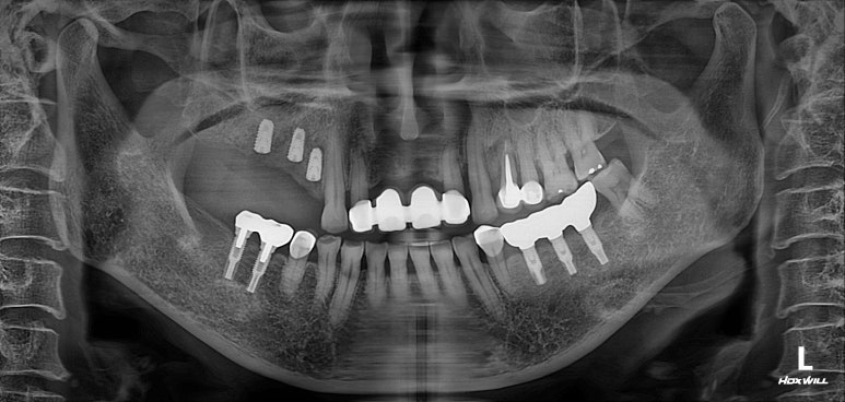 임플란트 주위염이 심하면? 임플란트 재수술을 잘하는 치과에 방문해보세요. 관련 이미지 16