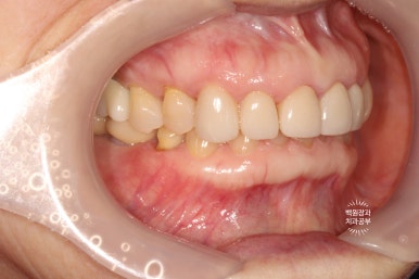 삐뚤빼뚤 앞니 세로 금  - 신경치료 없이 지르코니아 크라운으로. 상악동뼈이식술 임플란트. 관련 이미지 21