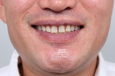 신사역 무삭제 라미네이트 : 레브네이트 내츄럴 최소삭제 비니어. 50대 앞니 벌어짐 비용/후기/얼굴사진. 관련 이미지 17