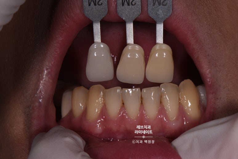 레브네이트 엑스퍼트 ; 유튜버가 선택한 앞니 라미네이트. 앞니 레진 벌어짐을 자연스러우면서 화사하게 바꿔봅시다. 신사역 치과. 치료후기/비용/가격. 관련 이미지 7