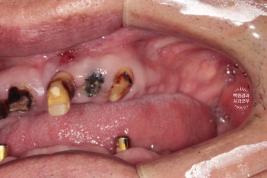 임플란트틀니 - 오버덴쳐. 오스템BA임플란트 이용한 최고의 가성비 치료. 치료과정/치료기간/비용/후기. 관련 이미지 4