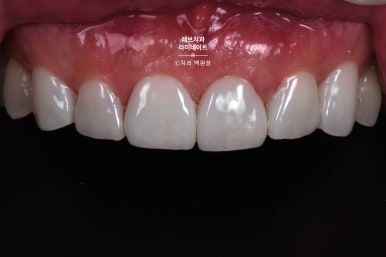 신사역 무삭제 라미네이트 : 레브네이트 내츄럴 최소삭제 비니어. 50대 앞니 벌어짐 비용/후기/얼굴사진. 관련 이미지 16
