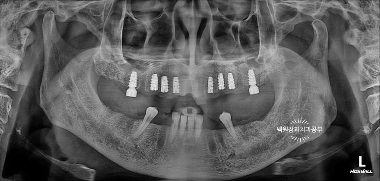 오스템임플란트 네비게이션 전체 임플란트 치료일기. 치료과정/치료기간/비용/솔직후기. 관련 이미지 5