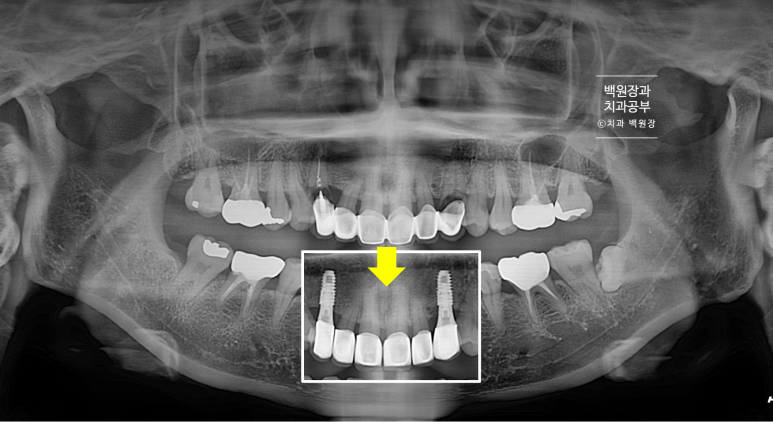 크라운 앞니 충치로 냄새가 나요 - 최소한의 임플란트와 씌우는 치료. 치료과정/기간/비용. 관련 이미지 18