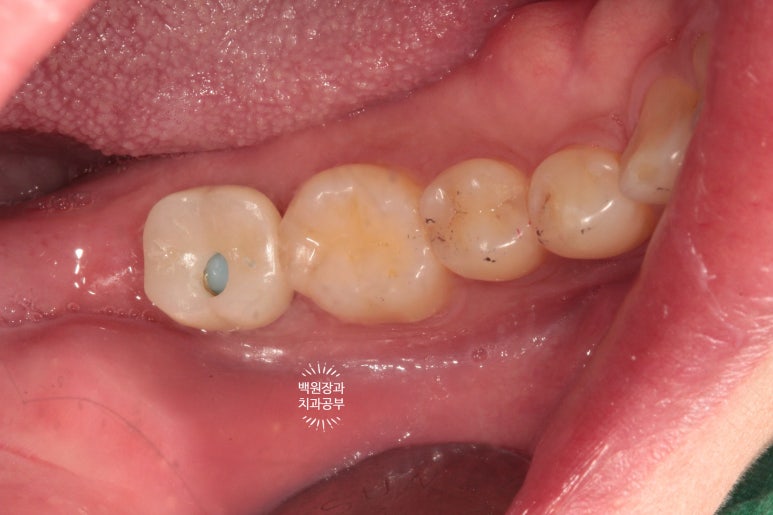 아래 어금니가 없어 위 어금니가 내려왔어요. 부분 교정을 곁들인 스트라우만 임플란트 수술. 억울한 신경치료를 피해보자. 치료과정/치료기간/비용/후기. 관련 이미지 11