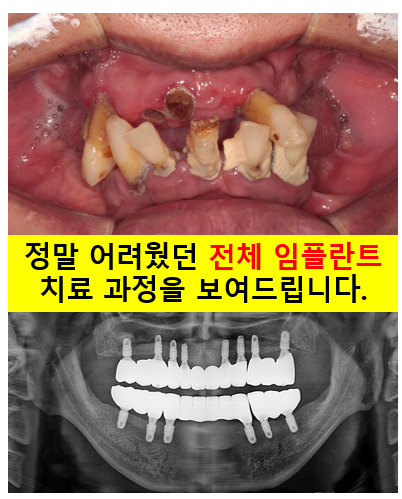 만성치주염으로 인해 아주 좁아진 잇몸뼈에 광범위한 뼈이식 + 전체임플란트. 신사 레브치과. 관련 이미지 1