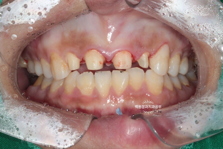 앞니에 잇몸염증과 충치가 심해요. 앞니 지르코니아 크라운 성공 후기. 치료과정/치료기간/비용/전후비교. 관련 이미지 17