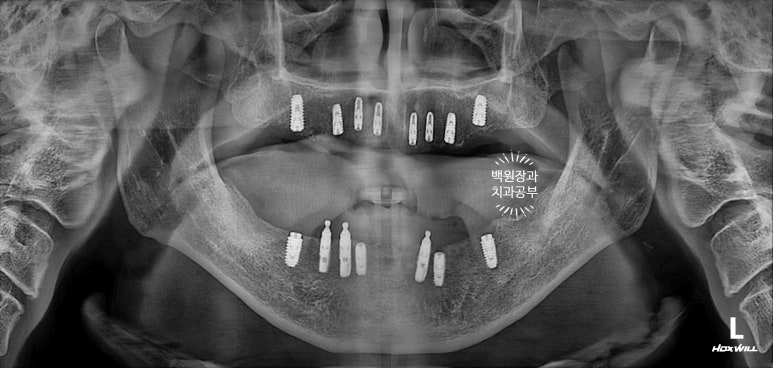 불편한 틀니를 아직도 쓰시나요? 전체 임플란트 치료비용/치료기간/치료과정. 관련 이미지 12