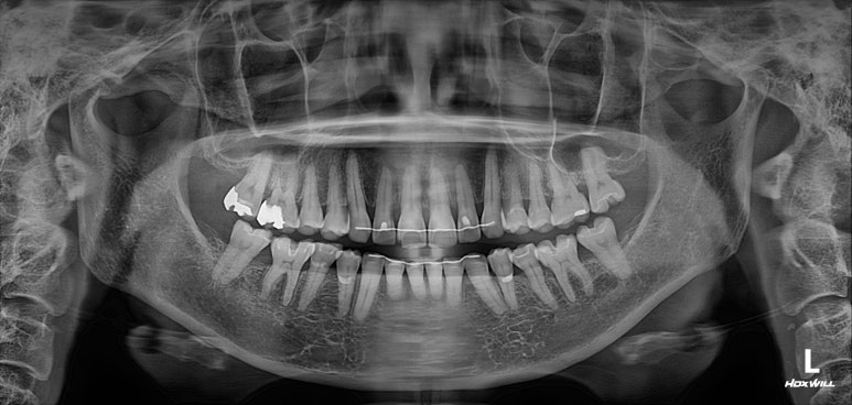 삐뚤어진 앞니를 8개월만에 가지런하게 만드는 50대 성인부분교정. 신사역 교정치과. 치료과정/기간/비용. 관련 이미지 23