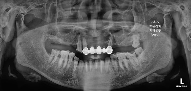 뿌리만 남은 앞니, 어금니가 없어 교합이 무너진 증례. 흡연자의 전체 오스템BA임플란트 재건증례. 치료과정/치료기간/비용/후기. 관련 이미지 5