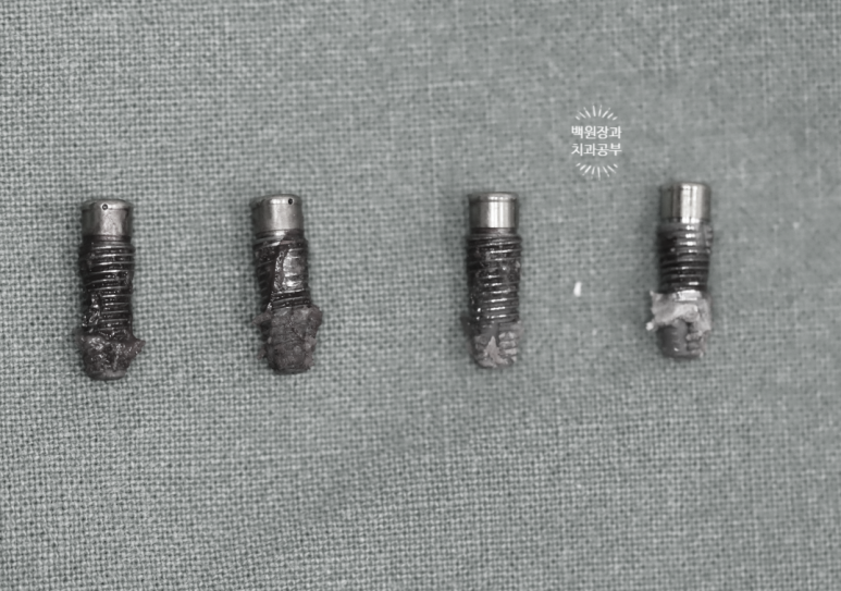 임플란트에서 고름이 나와요. 임플란트 주위염 그리고 재수술을 위한 준비. 치료과정/치료기간/비용/후기. 관련 이미지 10