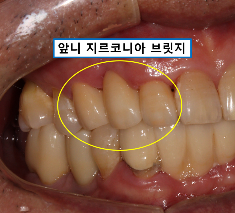 치주염 앞니 잇몸 염증으로 흔들릴 때 - 앞니 브릿지와 임플란트 장단점, 비용. 치료과정과 결과를 눈으로 보여주는 치과. 관련 이미지 19