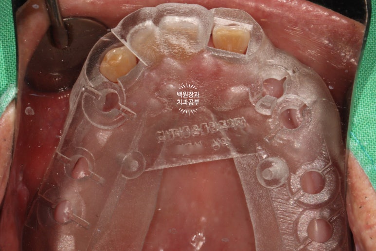 임플란트장인의 마음으로 8개월간 전체임플란트 완성. 치주과 전문의. 관련 이미지 11