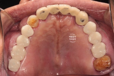 뿌리만 남은 앞니, 어금니가 없어 교합이 무너진 증례. 흡연자의 전체 오스템BA임플란트 재건증례. 치료과정/치료기간/비용/후기. 관련 이미지 19