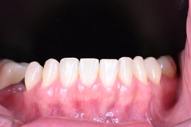 신사역 라미네이트. 결혼식 전 앞니 고민, 얇은 세라믹 레브네이트로 해결! 관련 이미지 7