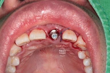 앞니 머리가 기둥째 부러졌어요. 발치 동시 뼈이식 오스템 BA 임플란트. 치료과정/치료기간/비용/후기. 압구정 치과. 관련 이미지 14
