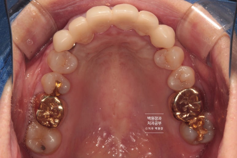 크라운 앞니 충치로 냄새가 나요 - 최소한의 임플란트와 씌우는 치료. 치료과정/기간/비용. 관련 이미지 9