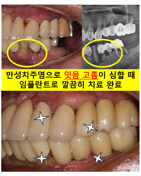 잇몸 염증 고름이 심했던 부위 - 만성치주염 진단하고 임플란트로 깔끔하게 치료! 신사역 치과 관련 이미지 1