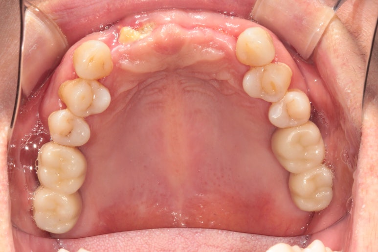 앞니가 풍치로 흔들거려요. 심한 치주염인데 임플란트 가능할까요? 치료과정/치료기간/비용/성공후기. 신금호역 치과 추천. 관련 이미지 24