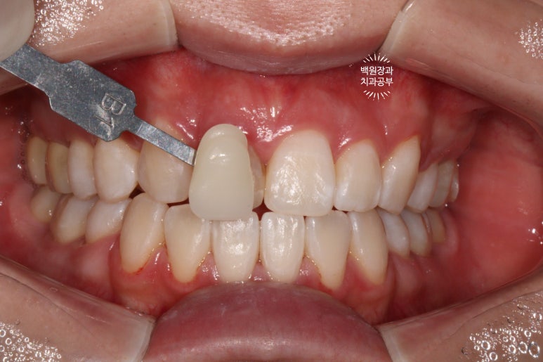 잇몸 성형과 치아미백 그리고 지르코니아 20대 앞니 크라운 치료. 치료과정/기간/비용. 관련 이미지 9