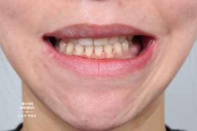 레브네이트 베이직. 치아미백과 치아교정을 한번에! 치아삭제 사진 있음. 신사역 치과 앞니라미네이트 모델/비용/후기. 관련 이미지 24