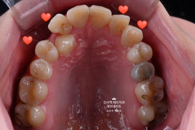 신사역 치과. 아나운서 면접 전 앞니 벌어진 공간을 라미네이트로만 해결할 수 있었던 사연.. 관련 이미지 13