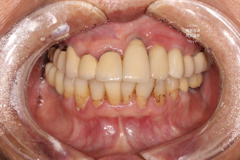 스트라우만 임플란트로 이뽑고 바로심는치과 - 믿고 사용하는 세계 1위 스위스 임플란트 회사. 관련 이미지 20