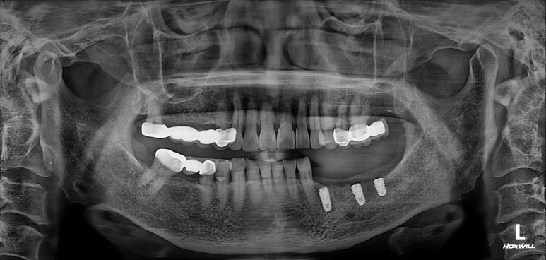 어금니 임플란트 주변 잇몸이식수술 - 저는 해야한다고 생각합니다. (feat. 대한치과의사협회 논문 + 치주과전문) 관련 이미지 17
