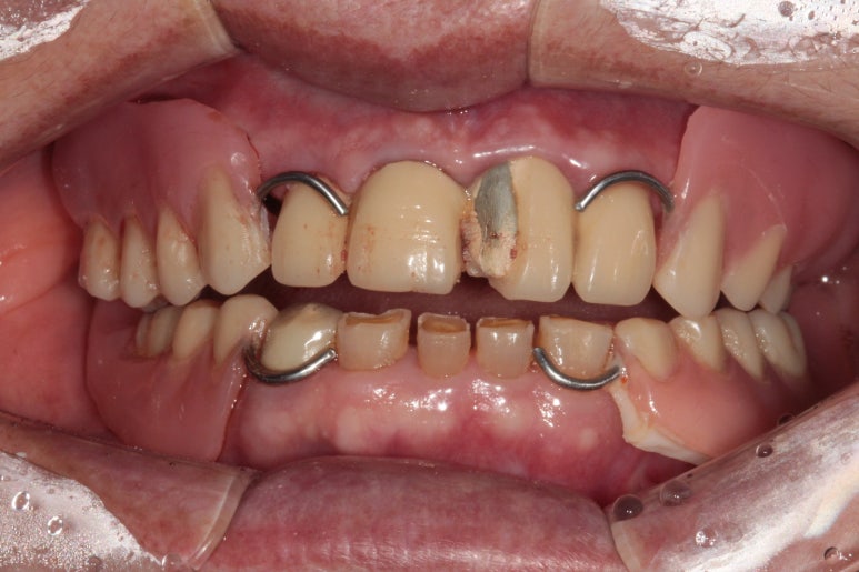 어금니 여러개가 없어요. 전체 임플란트와 앞니 크라운을 통한 완벽한 재건!! 치료과정/치료기간/비용/후기. 관련 이미지 33