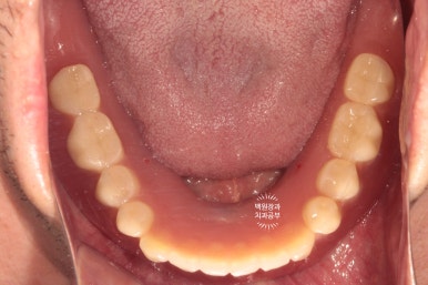 임플란트틀니 - 오버덴쳐. 오스템BA임플란트 이용한 최고의 가성비 치료. 치료과정/치료기간/비용/후기. 관련 이미지 20