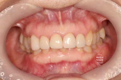 삐뚤빼뚤 앞니 세로 금  - 신경치료 없이 지르코니아 크라운으로. 상악동뼈이식술 임플란트. 관련 이미지 19