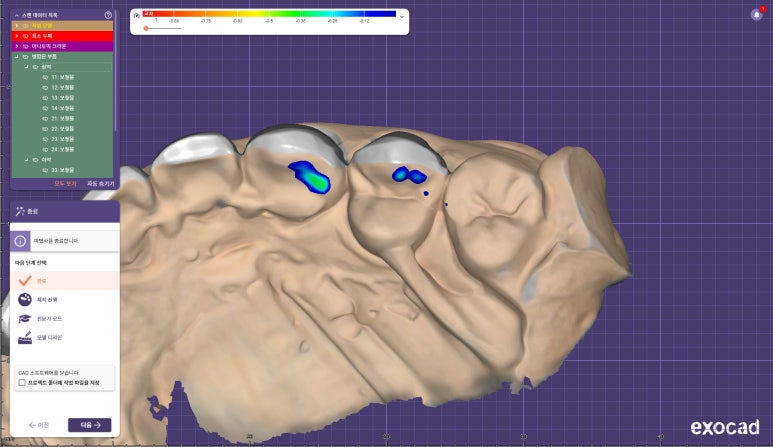 신사역 라미네이트. 결혼식 전 앞니 고민, 얇은 세라믹 레브네이트로 해결! 관련 이미지 14