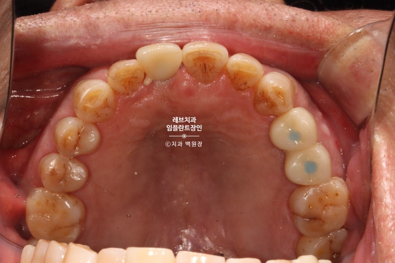 앞니 부러짐? 뽑고 바로 임플란트 + 뼈이식. 앞니 흔들림? 뽑고 1달 기다리고 임플란트 + 뼈이식. 신사역 치과 후기/비용/과정. 관련 이미지 10