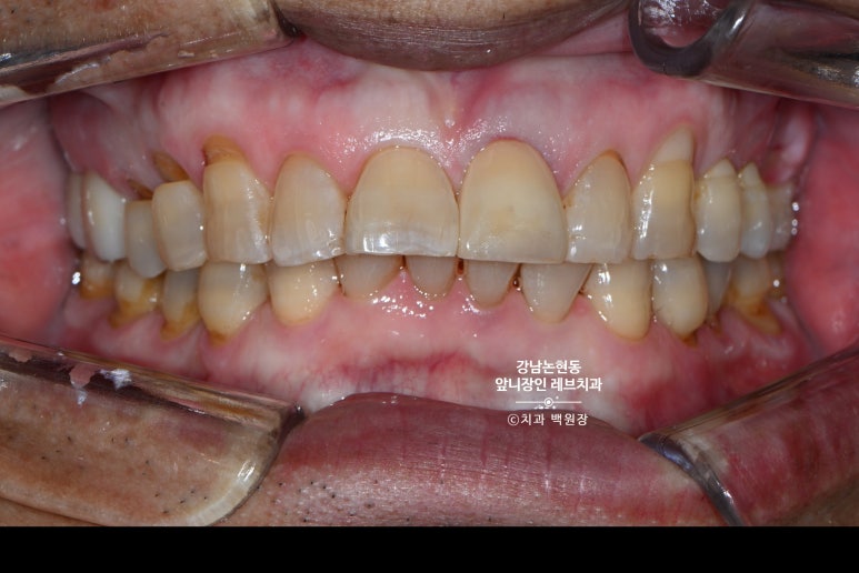 강남논현동치과 60대 치아부러짐 - 신경치료하고 기둥심고 앞니 크라운 잘하는곳! 가격/과정/후기/부작용. 관련 이미지 13