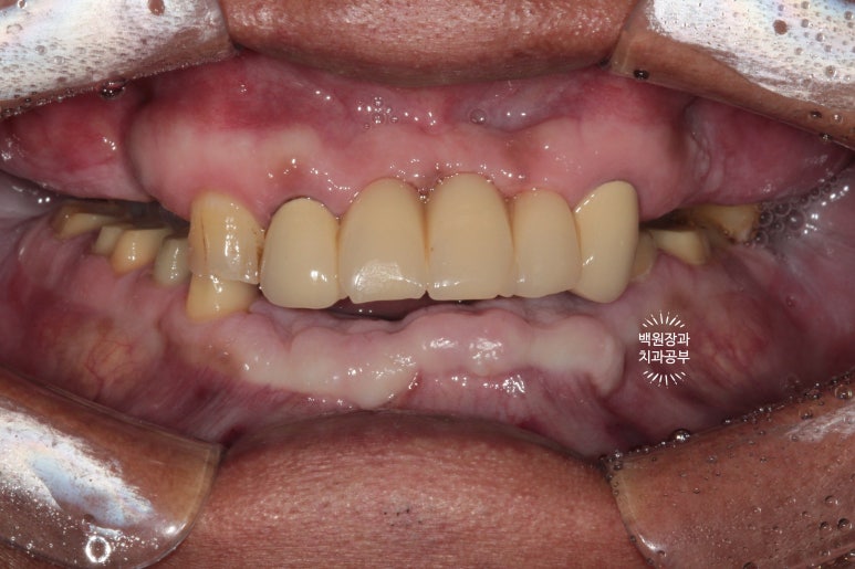 뿌리만 남은 앞니, 어금니가 없어 교합이 무너진 증례. 흡연자의 전체 오스템BA임플란트 재건증례. 치료과정/치료기간/비용/후기. 관련 이미지 13