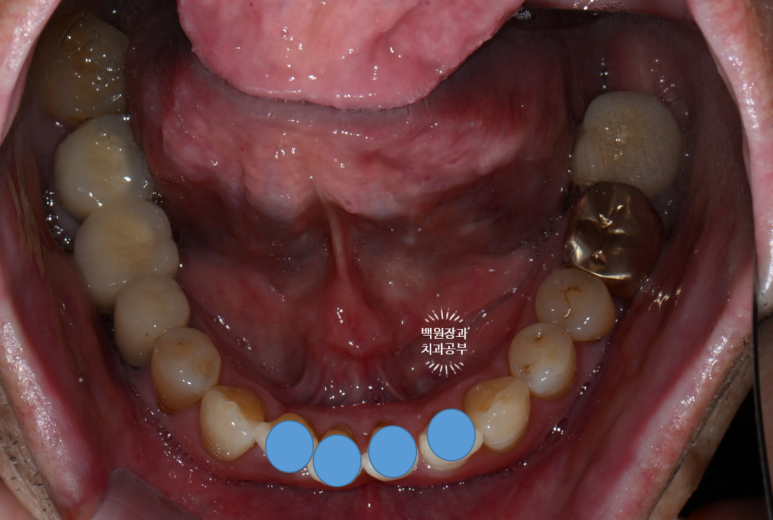 Seoul Sinsa Station [Lev Dental Clinic] For chronic periodontitis, extract the lower front teeth and make the crown look even more real than the real thing with an implant. image 5
