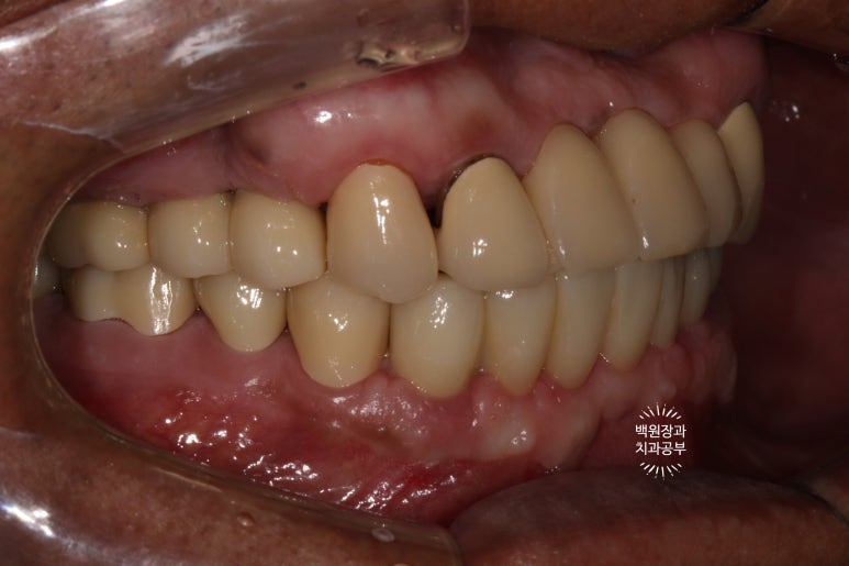 뿌리만 남은 앞니, 어금니가 없어 교합이 무너진 증례. 흡연자의 전체 오스템BA임플란트 재건증례. 치료과정/치료기간/비용/후기. 관련 이미지 27