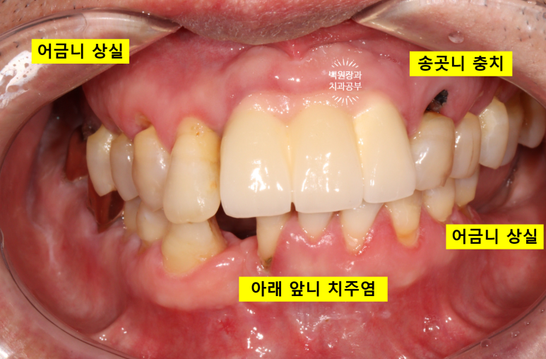 치주염으로 흔들리는 앞니부터 어금니 뼈이식 임플란트까지 - 5개월간 정성스러운 치료 과정. 관련 이미지 4