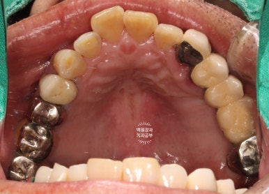 아래 어금니 임플란트 6개면 틀니를 안써도 됩니다.  치주염 전문 착한치과. 치료기간/임시치아과정/후기/비용. 관련 이미지 34