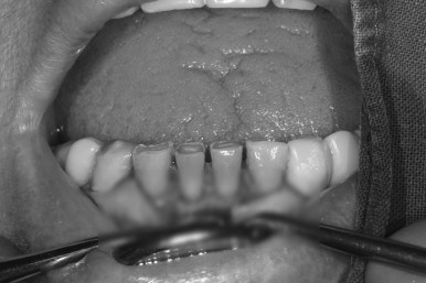 어금니 여러개가 없어요. 전체 임플란트와 앞니 크라운을 통한 완벽한 재건!! 치료과정/치료기간/비용/후기. 관련 이미지 17