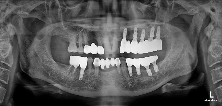 치주염 앞니 잇몸 염증으로 흔들릴 때 - 앞니 브릿지와 임플란트 장단점, 비용. 치료과정과 결과를 눈으로 보여주는 치과. 관련 이미지 17