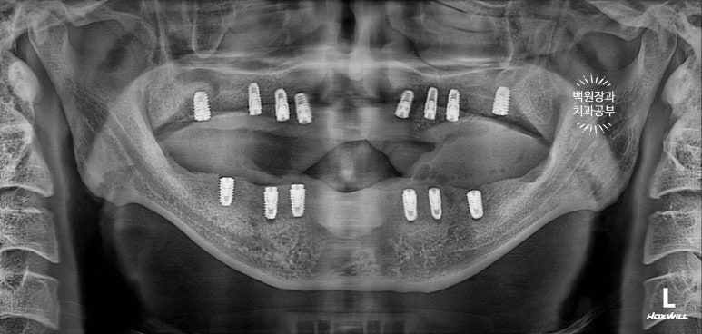 만성치주염으로 인해 아주 좁아진 잇몸뼈에 광범위한 뼈이식 + 전체임플란트. 신사 레브치과. 관련 이미지 39