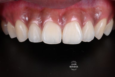 What About Laminates at Sinsa Station? Rev Dental Clinic’s Revnate. image 8