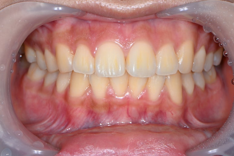 앞니치아미백 비용 들인만큼 잘되는 치과 찾는법. 신사역 치과 미백 성지. 관련 이미지 11