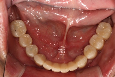 아래 어금니 임플란트 6개면 틀니를 안써도 됩니다.  치주염 전문 착한치과. 치료기간/임시치아과정/후기/비용. 관련 이미지 28