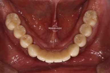 오스템임플란트 네비게이션 전체 임플란트 치료일기. 치료과정/치료기간/비용/솔직후기. 관련 이미지 36