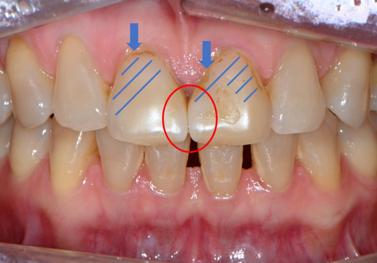레브네이트 엑스퍼트 - 앞니 무삭제 라미네이트. 40대 벌어진 앞니에 변색된 레진은 이제 그만! 압구정 치과 추천 전후/비용. 관련 이미지 4
